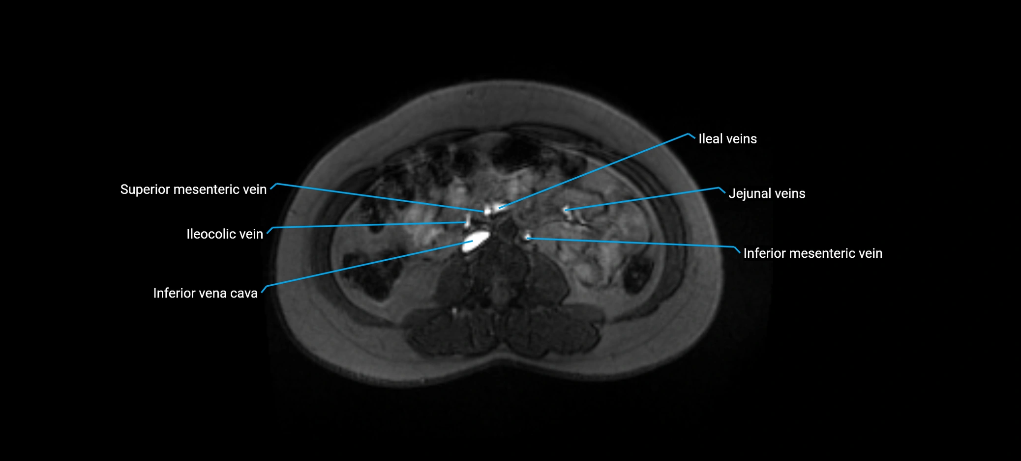 MRV abdomen pelvis & lower limb axial cross sectional anatomy labelled MRI image 92 (1).webp